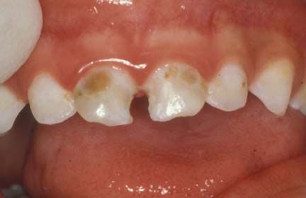 dental cavities